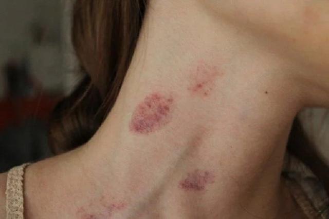Hickey là gì Hickey là gì