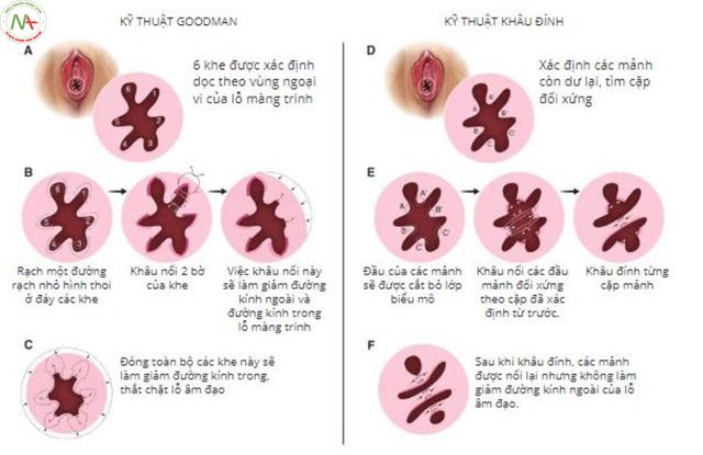 3. Phẫu thuật và thuốc để hồi phục màng trinh: So sánh hiệu quả và rủi ro của cả hai phương pháp này trong việc khôi phục lại màng trinh như ban đầu.